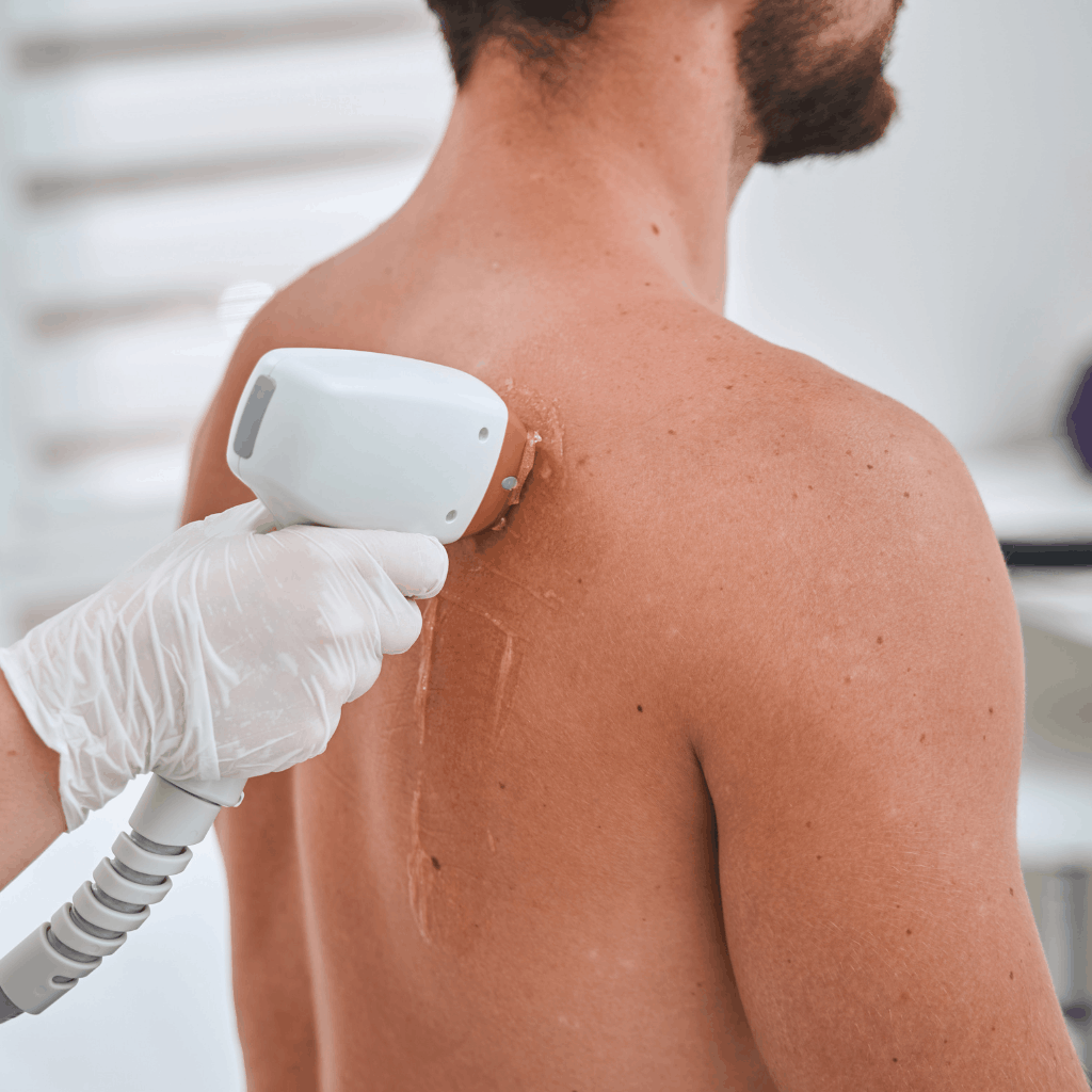 épilation laser définitive dos pour homme au centre Céor à Muret