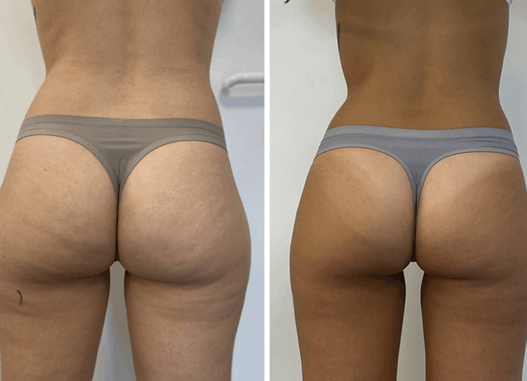 reduction cellulite resultats soin minceur laser diode focalisé au centre Céor à Muret