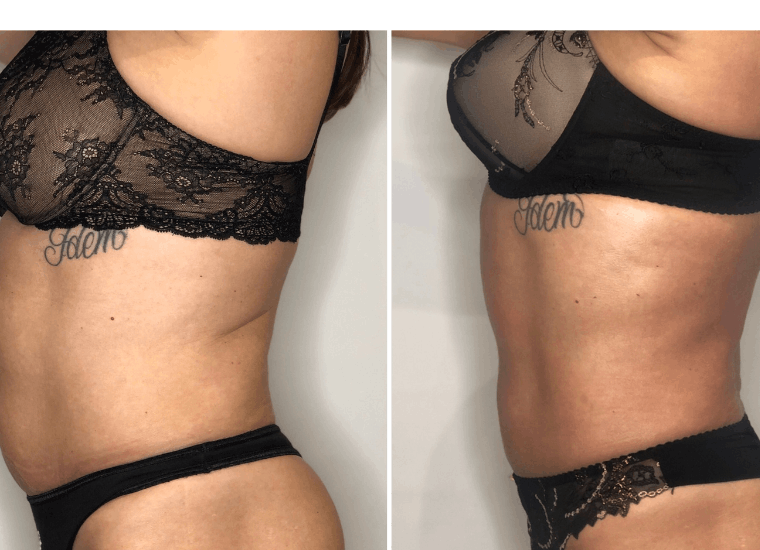 resultats avant après soin anti cellulite laser diode focalisé centre Céor à Muret