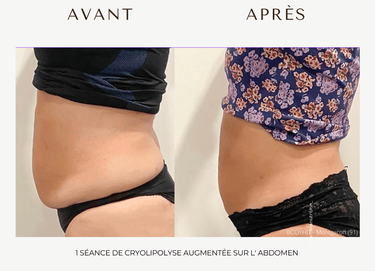 resultats clients cryolipolyse au centre céor à Muret