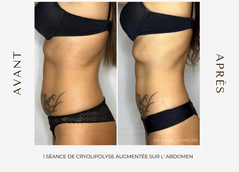 resultat cryolipolyse au centre céor à Muret